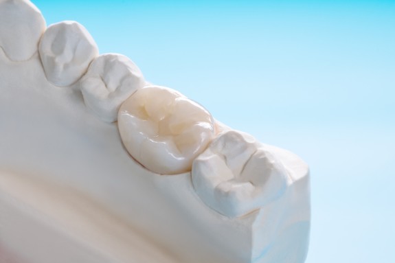 Gibsmodell eines Unterkiefers mit eingesetztem Implantat